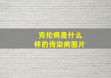 克伦病是什么样的传染病图片