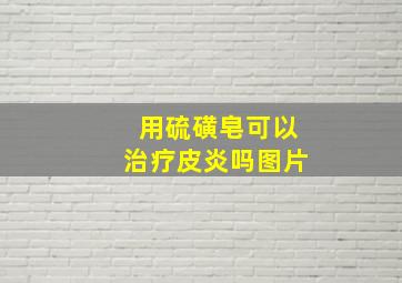 用硫磺皂可以治疗皮炎吗图片