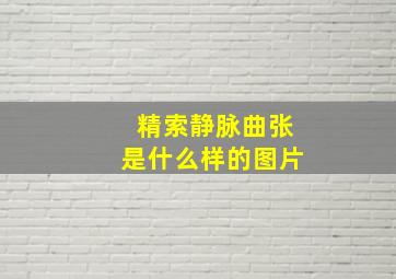 精索静脉曲张是什么样的图片