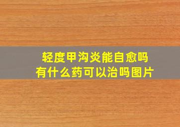 轻度甲沟炎能自愈吗有什么药可以治吗图片