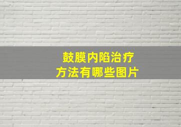 鼓膜内陷治疗方法有哪些图片